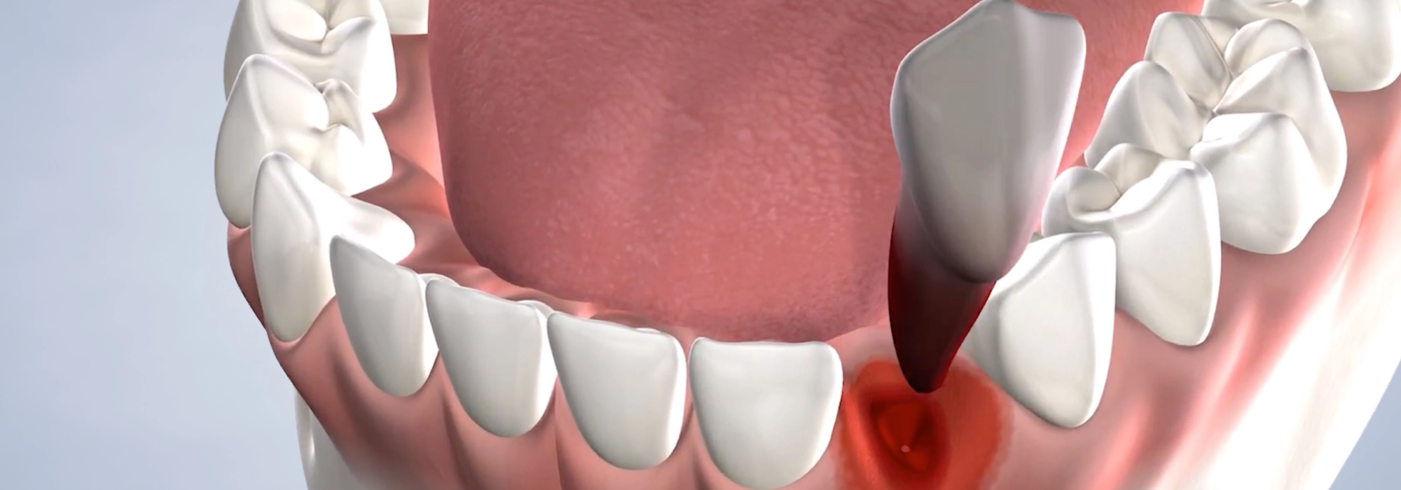 tooth-extraction-landscape.webp
