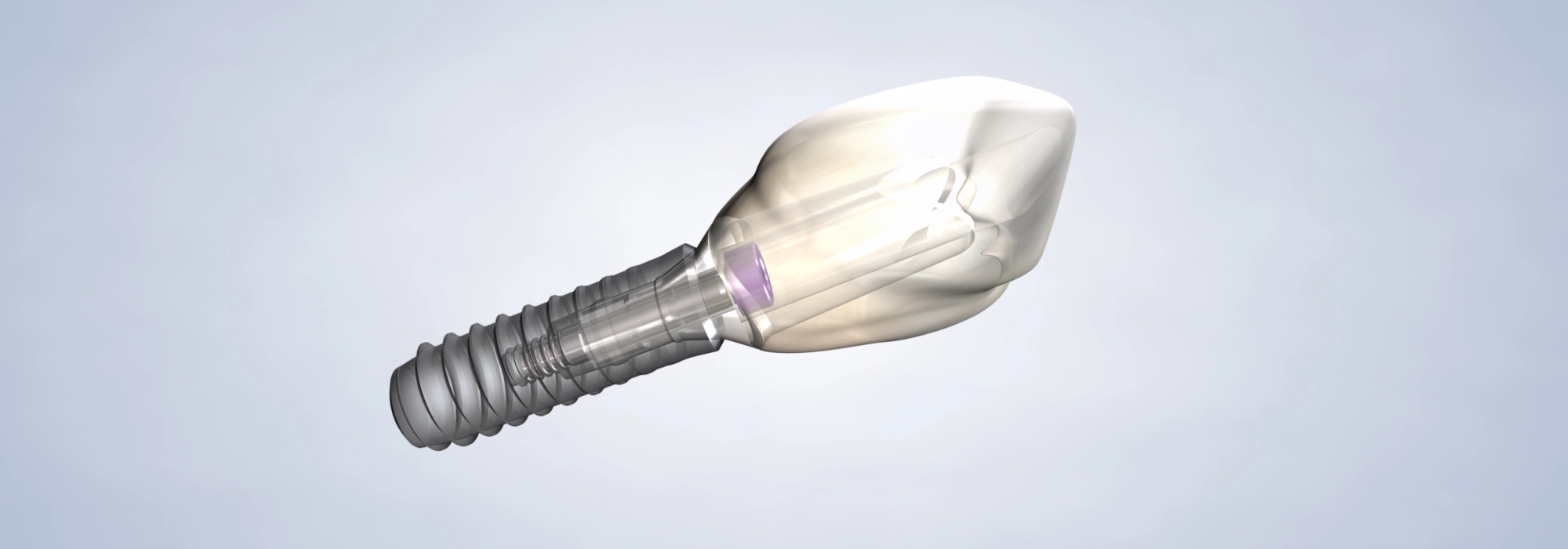 dental-implants-landscape.webp