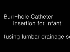 Burr Hole Trephination for Infants