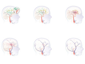 모야모야병 suzuki grade 단계별