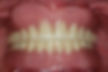 implant case 8-2