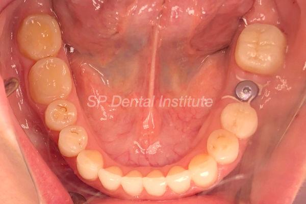 restoration case 2-1