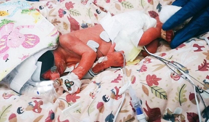 Baby Izzy with severe early-onset IUGR