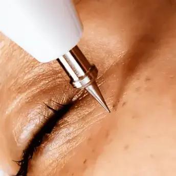 Jato de plasma aplicado na região dos olhos para tratamento de manchas e rejuvenescimento da pele