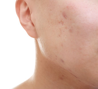 Representação visual de cicatrizes de acne e textura irregular da pele facial.