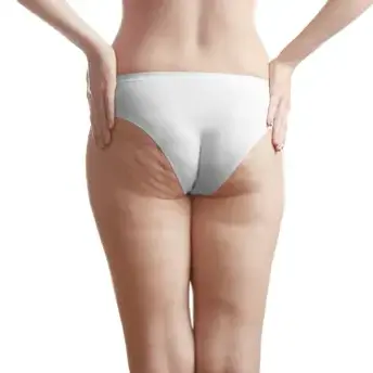 Representação visual de celulite na região dos glúteos e coxas.