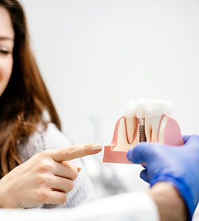 dental%20implants_edited.jpg