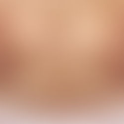 woman with cesarean section scar