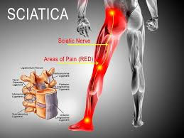 Sciatica Relief Through Spinal Decompression