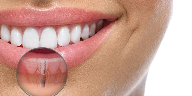 Implantes dentales ¿es lo que necesito?