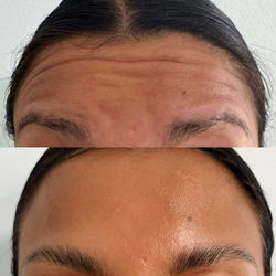Forehead wrinkle tox treatment