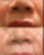 Laugh line rejuvenation
