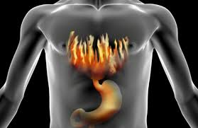 Focus on... heartburn and acid reflux