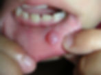 mucocele