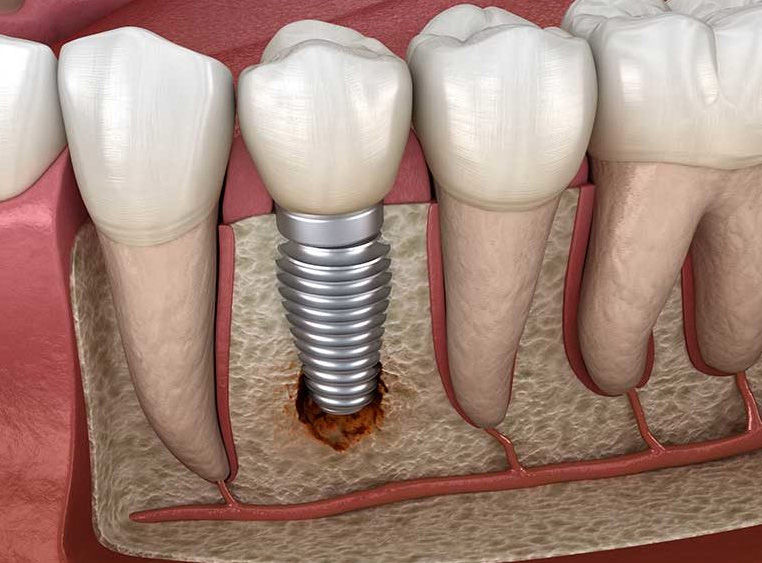Todo lo que necesitas saber sobre los implantes dentales