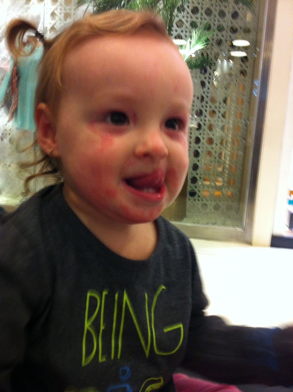 No auge da dermatite atópica...