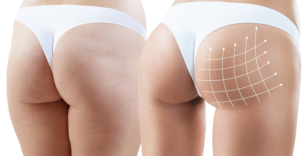The Truth about Buttock Fillers - Revolutionizing Beauty Standards