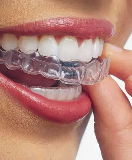 kfn-invisalign (1).webp
