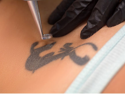 Laser Tattoo Removal: How it Works & All You Need to Know