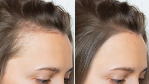 أفضل الحلول الفعالة لتساقط الشعر في دبي