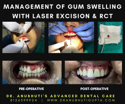 Dr Anubhutis ADC perio laser case