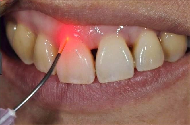 Laser Dentistry