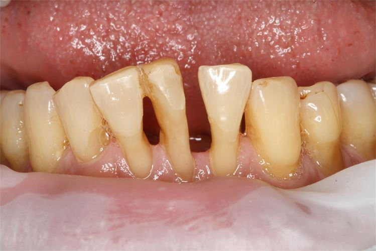 Advanced Gum Treatment