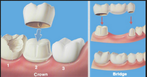 Fixed Crown & Bridge