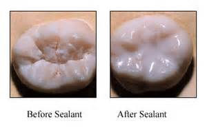 Dental sealant