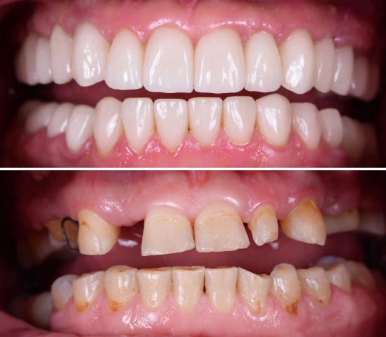 Full Mouth Rehabilitation