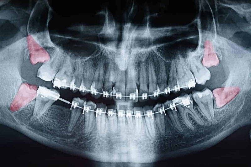 Wisdom Tooth Removal