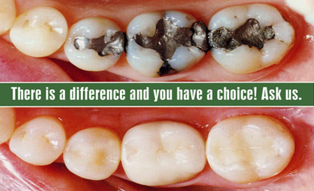 Dental Fillings
