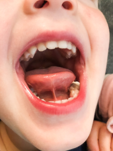 Tongue Tie Release