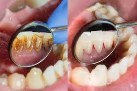 Teeth Cleaning & Polishing
