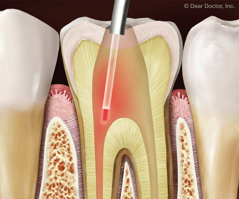 Laser Disinfection
