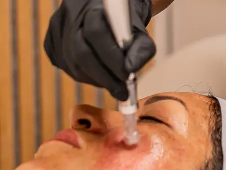 Expert Wrinkle Reduction in Shreveport: Rejuvenate Your Look