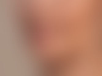 Non-Surgical Jowls and Jawline Contouring in Shreveport: Define Your Jawline