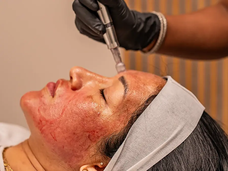 The Power of Collagen Stimulation in Louisiana: Restore Your Glow