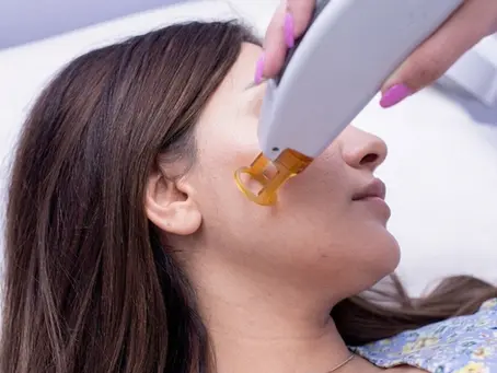 Sideburns Laser Hair Removal in Shreveport