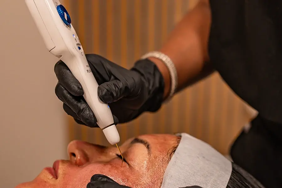Professional Skin Lesion Removal in Shreveport: Clear and Flawless Skin