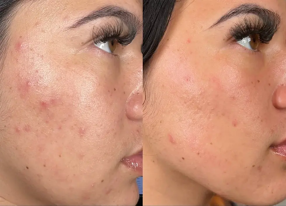 HydraFacial and Dermaplaning: The Ultimate Med Spa Combination for Flawless Skin