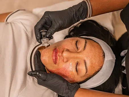 What Is a Chemical Peel? A Shreveport Beginner's Guide