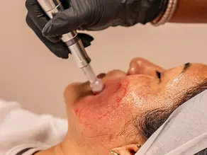 What is the Most Effective Microneedling Treatment?