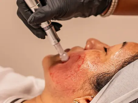 What is the Most Effective Microneedling Treatment?