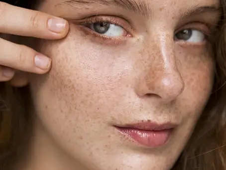 Is Microneedling or Laser Better for Sun Spots