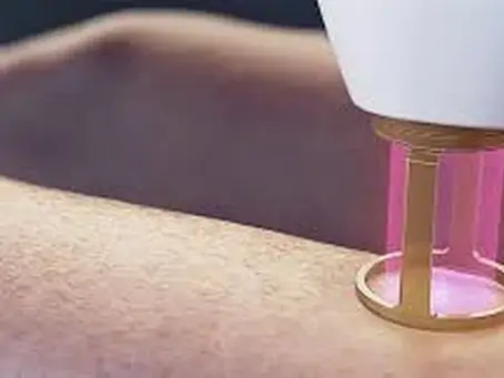 Perianal Laser Hair Removal in Shreveport and Bossier city