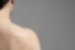 Face vs. Back Acne Laser Treatment: What's Different About Treating 'Bacne