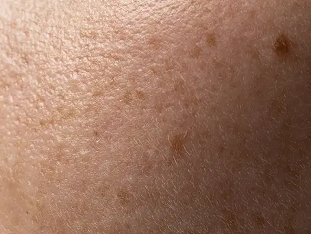 Is It Too Late to Fix Sun Damaged Skin