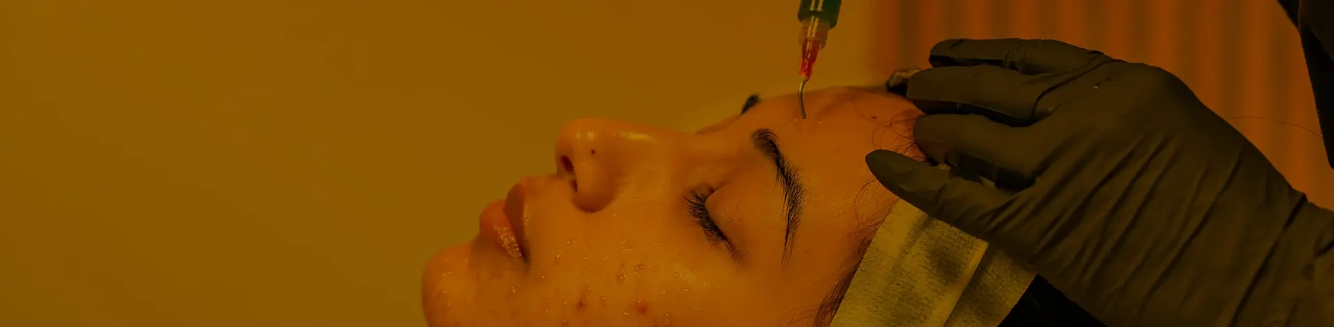 chemical peeling.webp