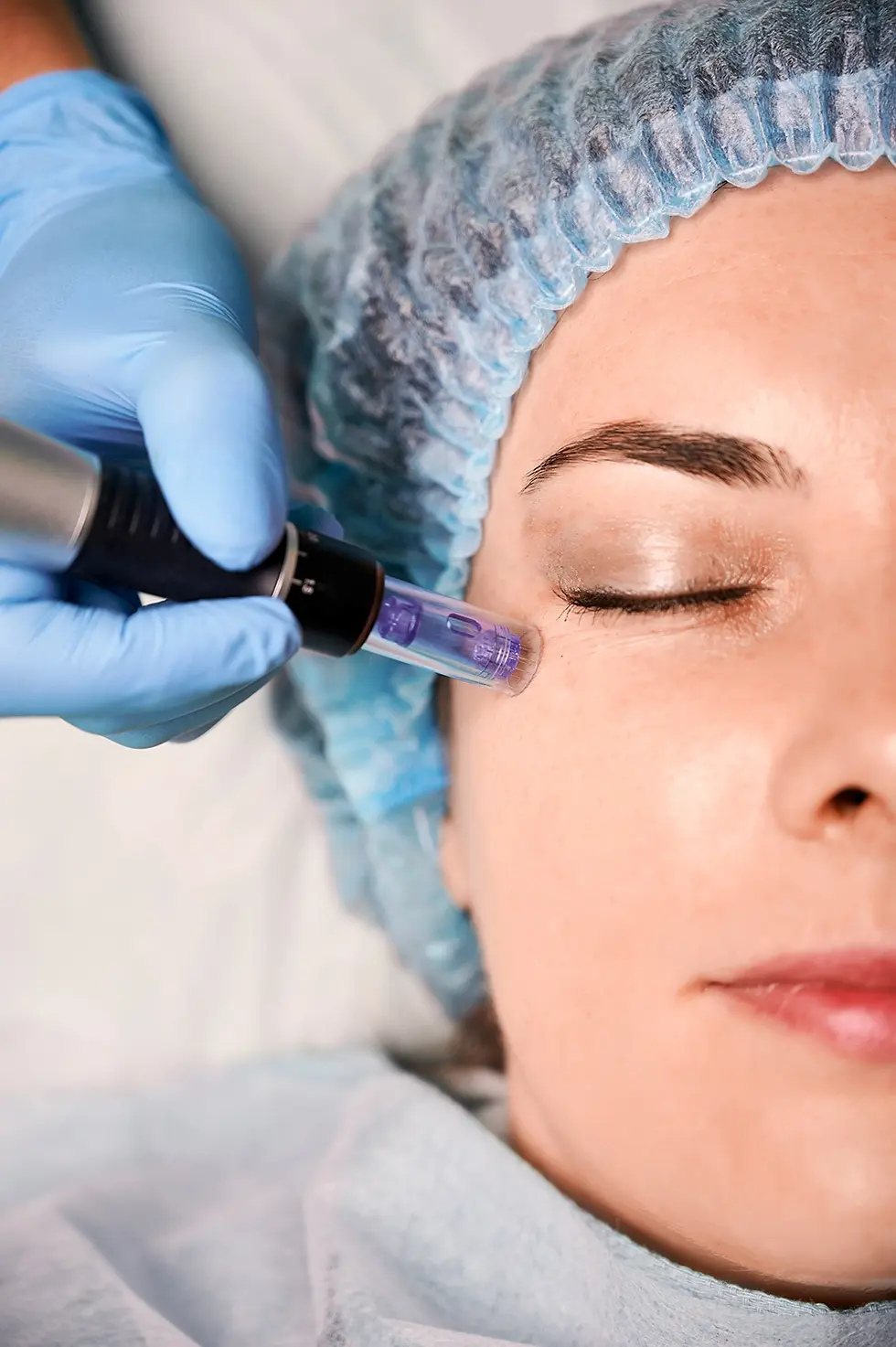 Microneedling With Exosomes Side Effects | Safety Guide | Shreveport, LA